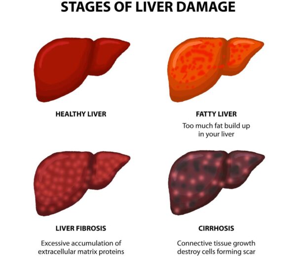 Fatty Liver