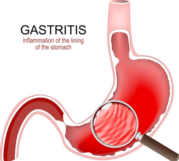 Gastritis